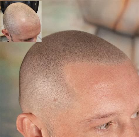 Scalp micro usa - Scalp micropigmentation requires intricate techniques. On average, there are over 100,000 follicles on the human head; this means our skilled practitioners’ implant pigments by hand 1,250 times per square inch. Hairline Ink typically charges between $1,800 and $3,200 for average clients’ needs and desired looks.